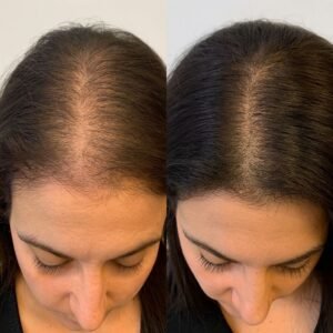 before after haargroei