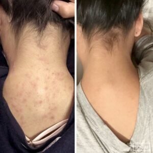 before after nek