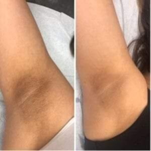 before after oksels