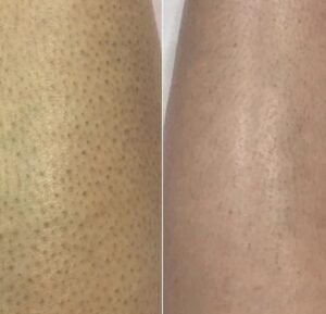 before after tbrima