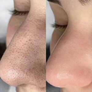 before and after neus